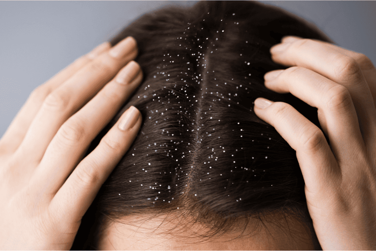 Dandruff