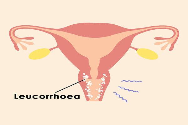 Leucorrhoea