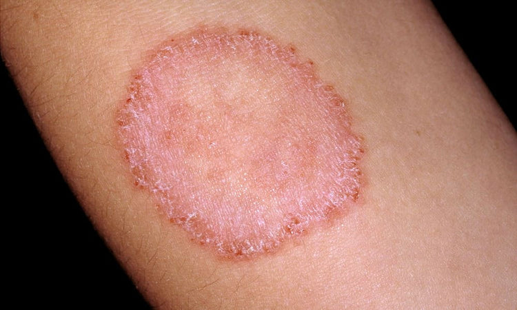 Ringworm