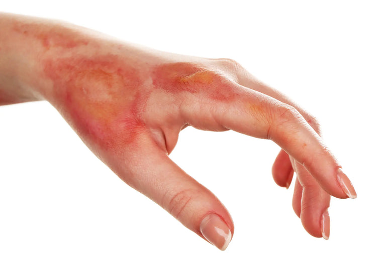 Skin Burn