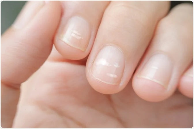 Calcium Deficiency