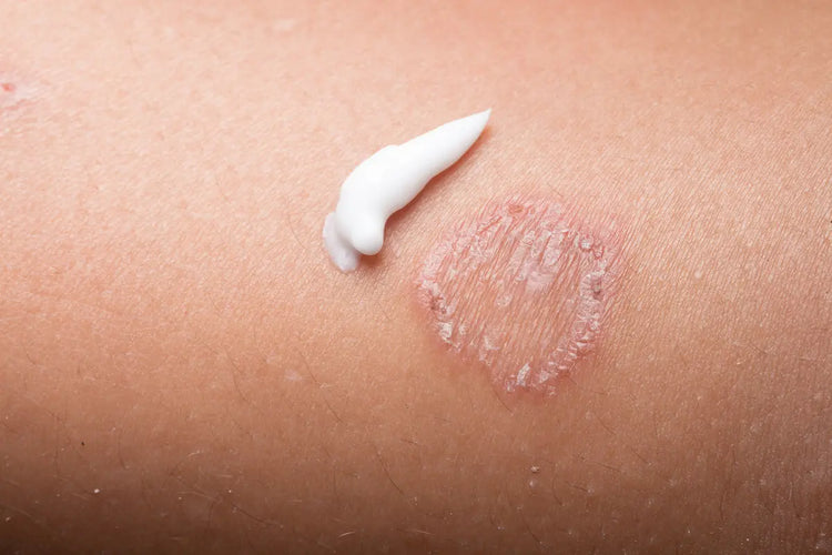 Fungal Skin Infection
