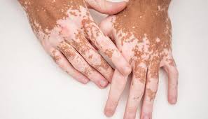 Pigmentation